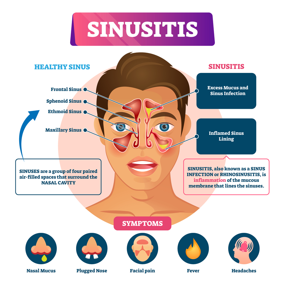 How Long Does Sinusitis Last?